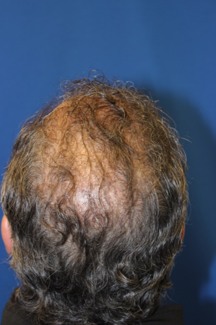 Follicular Unit Extraction Before & After Patient #3686