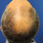 Follicular Unit Extraction Before & After Patient #3686