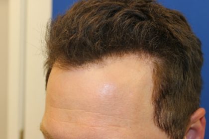 Follicular Unit Extraction Before & After Patient #3747