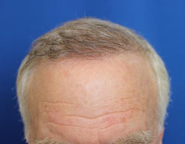 Follicular Unit Extraction Before & After Patient #3650
