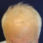 Follicular Unit Extraction Before & After Patient #3650
