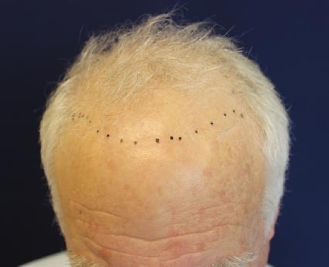 Follicular Unit Extraction Before & After Patient #3650