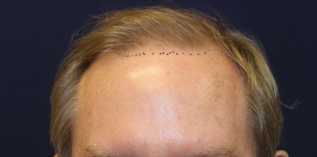 Follicular Unit Extraction Before & After Patient #3763