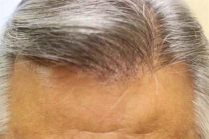 Follicular Unit Extraction Before & After Patient #3597