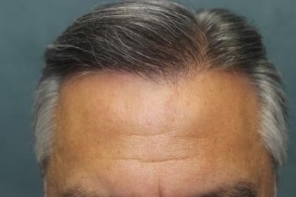 Follicular Unit Extraction Before & After Patient #3597