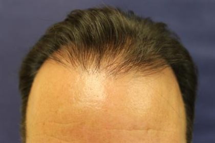 Follicular Unit Extraction Before & After Patient #3605