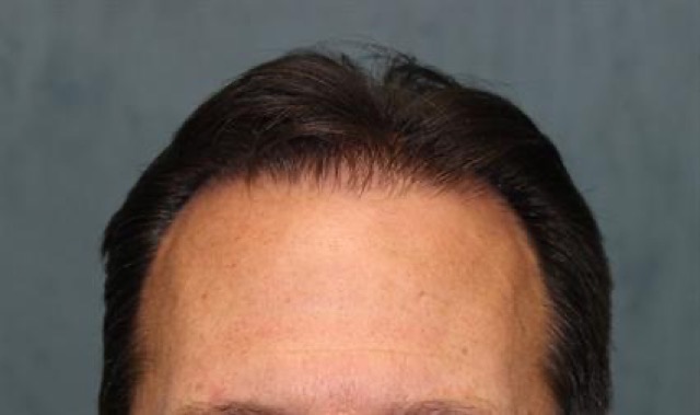 Follicular Unit Extraction Before & After Patient #3605