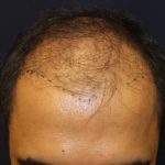 Follicular Unit Extraction Before & After Patient #3799