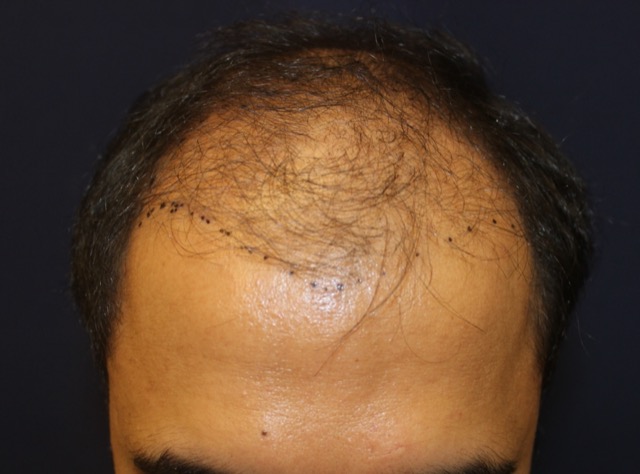 Follicular Unit Extraction Before & After Patient #3799