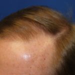 Follicular Unit Extraction Before & After Patient #3763