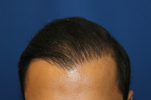 Follicular Unit Extraction Before & After Patient #3799