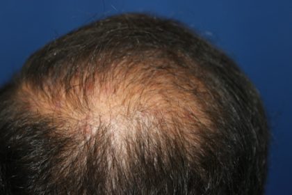 Follicular Unit Extraction Before & After Patient #3799