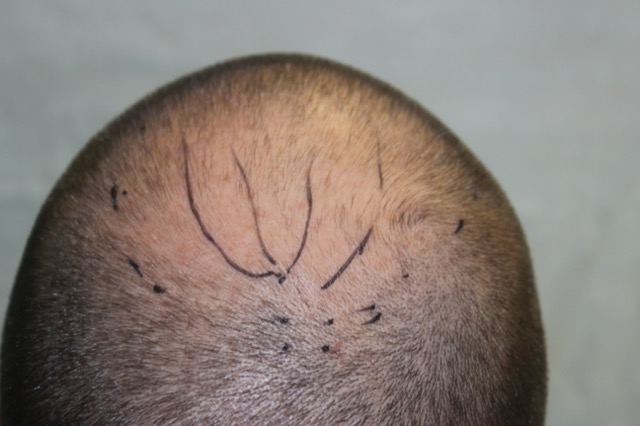 Follicular Unit Extraction Before & After Patient #3518