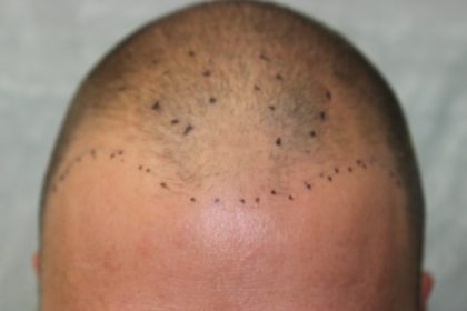 Follicular Unit Extraction Before & After Patient #3518