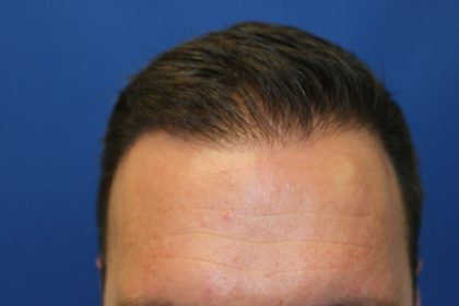 Follicular Unit Extraction Before & After Patient #3518