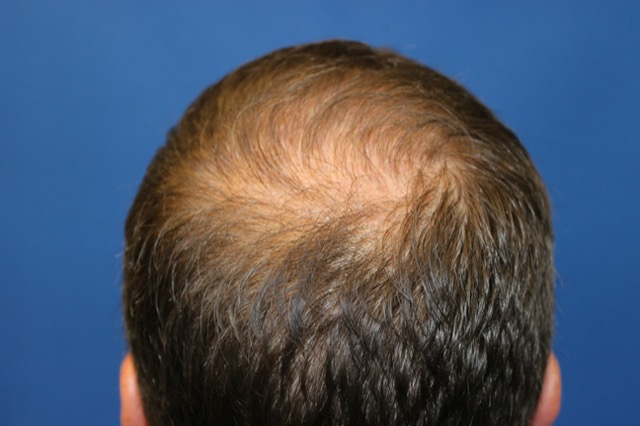 Follicular Unit Extraction Before & After Patient #3518