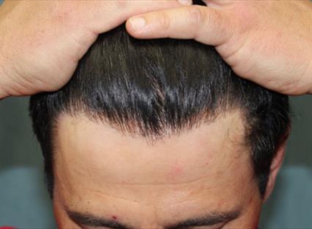 Follicular Unit Extraction Before & After Patient #3530