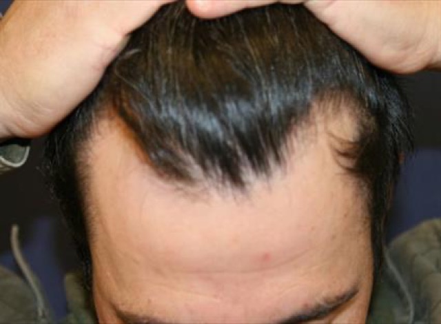 Follicular Unit Extraction Before & After Patient #3530