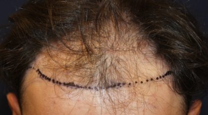 Follicular Unit Extraction Before & After Patient #3784