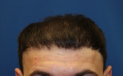 Follicular Unit Extraction Before & After Patient #3784