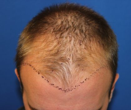 Follicular Unit Extraction Before & After Patient #3754