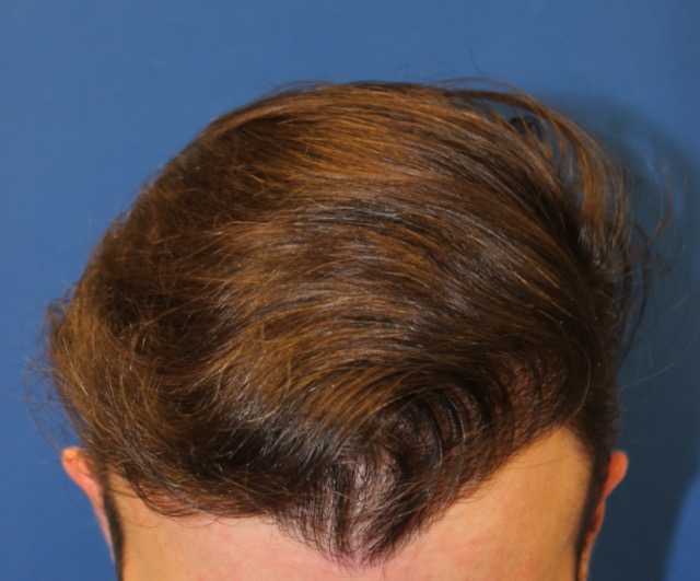 Follicular Unit Extraction Before & After Patient #3754