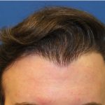 Follicular Unit Extraction Before & After Patient #3754