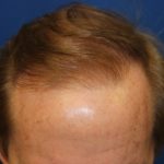 Follicular Unit Extraction Before & After Patient #3763