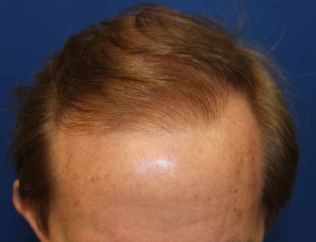 Follicular Unit Extraction Before & After Patient #3763