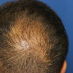 Follicular Unit Extraction Before & After Patient #3729