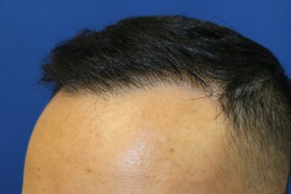 Follicular Unit Extraction Before & After Patient #3729