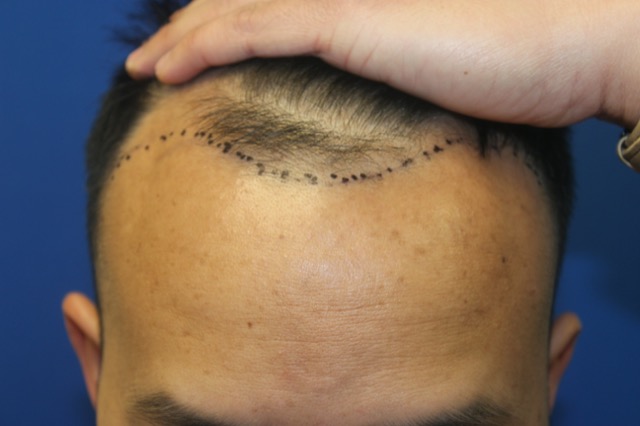Follicular Unit Extraction Before & After Patient #3729