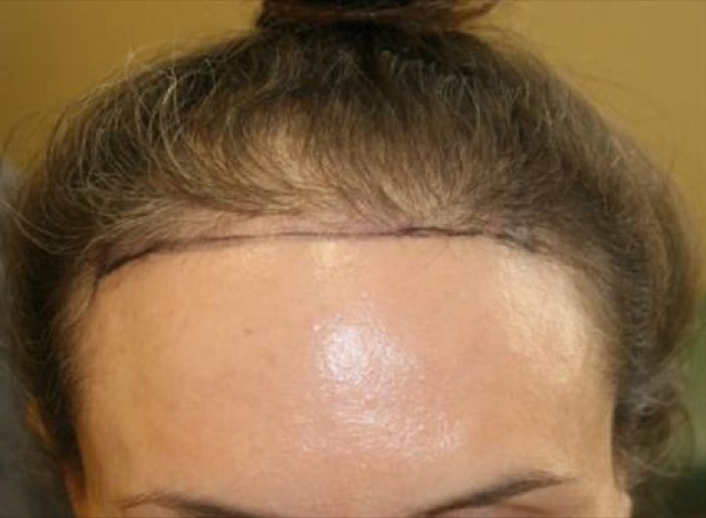 Follicular Unit Extraction Before & After Patient #3527