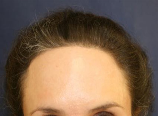 Follicular Unit Extraction Before & After Patient #3527