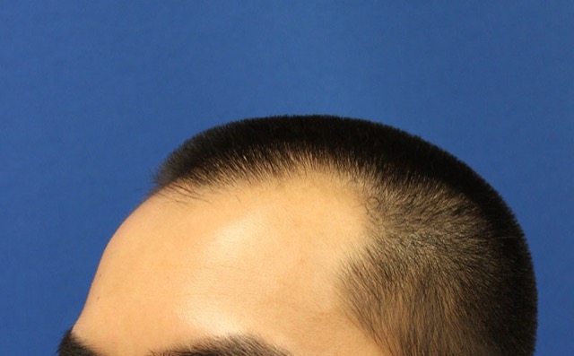 Follicular Unit Extraction Before & After Patient #3506