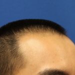 Follicular Unit Extraction Before & After Patient #3506