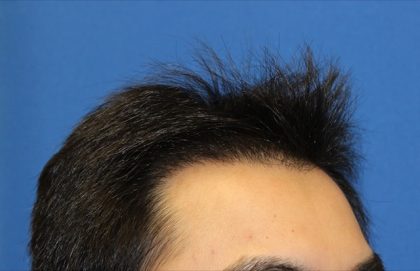 Follicular Unit Extraction Before & After Patient #3506