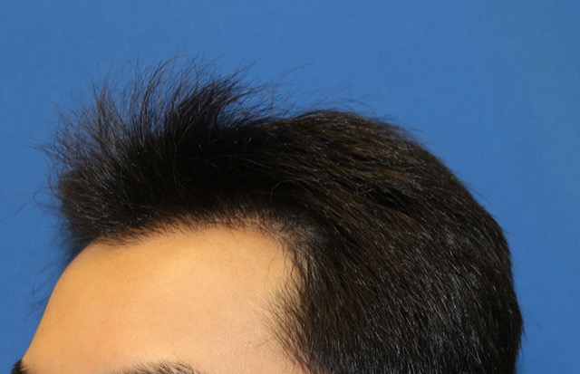 Follicular Unit Extraction Before & After Patient #3506