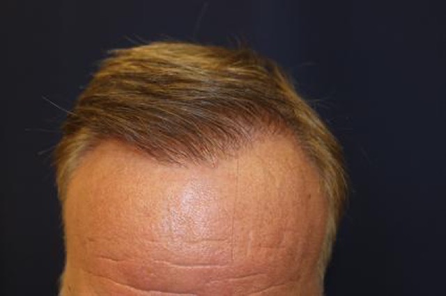 Follicular Unit Extraction Before & After Patient #3620