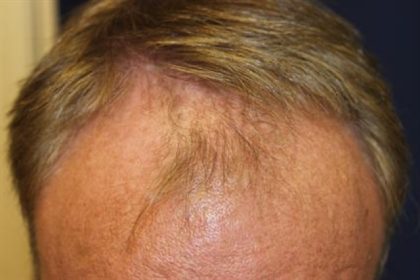 Follicular Unit Extraction Before & After Patient #3620