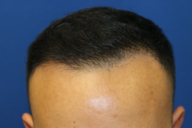 Follicular Unit Extraction Before & After Patient #3729