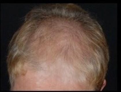 Follicular Unit Extraction Before & After Patient #3577