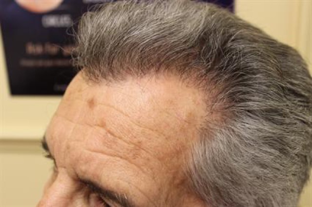 Follicular Unit Extraction Before & After Patient #3544