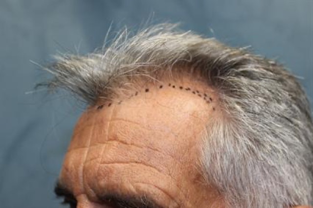 Follicular Unit Extraction Before & After Patient #3544