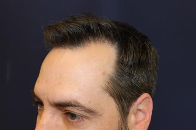 Follicular Unit Extraction Before & After Patient #3547