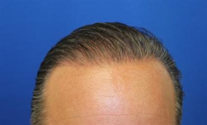 Follicular Unit Extraction Before & After Patient #3644