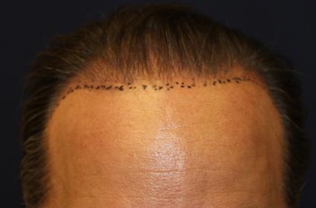 Follicular Unit Extraction Before & After Patient #3644