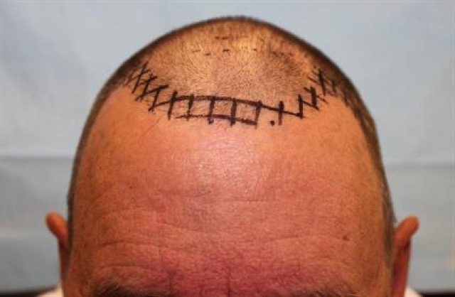 Follicular Unit Extraction Before & After Patient #3638