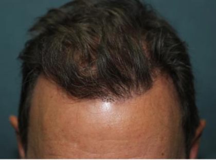 Follicular Unit Extraction Before & After Patient #3638