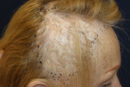 Follicular Unit Extraction Before & After Patient #3811